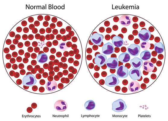 Leukemia Leukemia