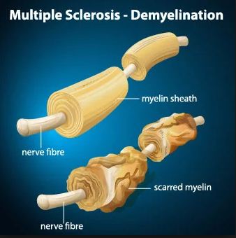 Multiple Sclerosis Multiple Sclerosis