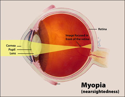 Myopia Myopia, Nearsightedness, Shortsightedness