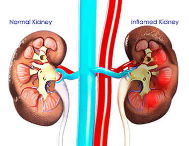 Irritable Bowel Syndrome Irritable Bowel Syndrome