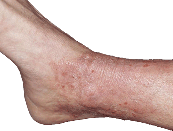 Neurodermatitis Neurodermatitis
