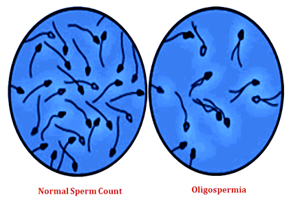 Oligospermia Oligospermia