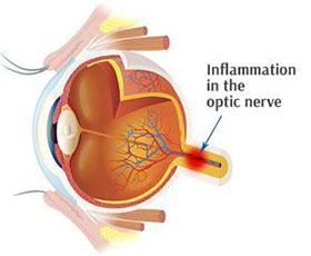 Optic Neuritis Optic Neuritis