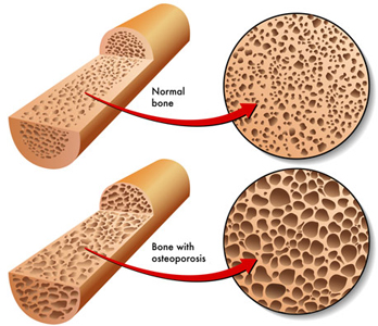 Low Bone Density (Osteoporosis) Low Bone Density, Osteoporosis