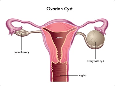 Ovarian cysts Ovarian cysts
