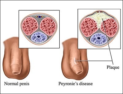 Peyronie's Disease Peyronie's Disease