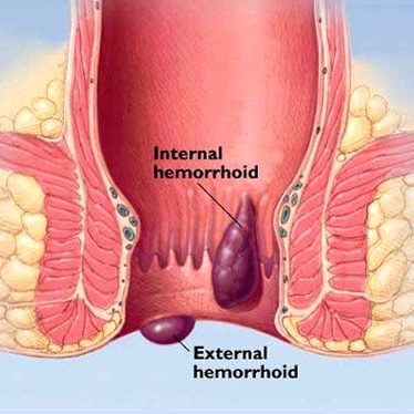 Hemorrhoids Hemorrhoids images - piles images
