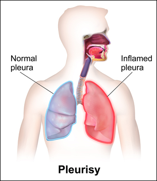 Pleurisy Pleurisy