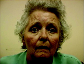 Progressive supranuclear palsy Progressive supranuclear palsy