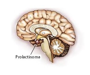 Prolactinoma Prolactinoma