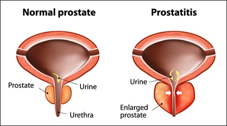 Prostatitis Prostatitis