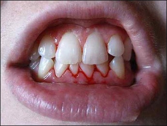 Pyorrhoea Pyorrhoea