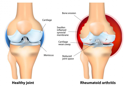 Rheumatoid arthritis Rheumatoid arthritis