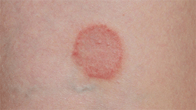 Ringworm Ringworm
