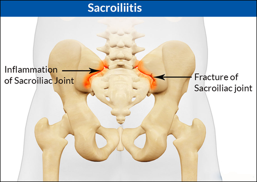 Sacroiliitis Sacroiliitis