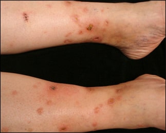 Sarcoidosis Sarcoidosis