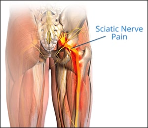 Sciatica Sciatica
