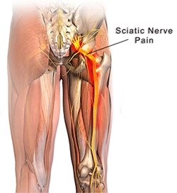 Sciatica Sciatica