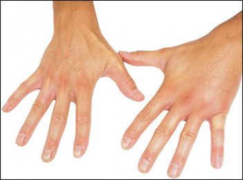 Scleroderma Scleroderma