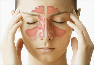 Sinusitis Sinusitis