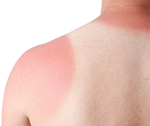 Sunburn Sunburn