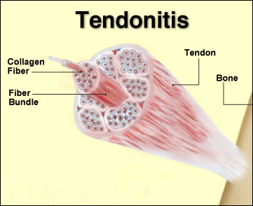 Tendonitis Tendonitis