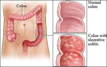 Ulcerative colitis Ulcerative colitis