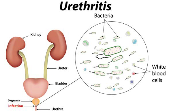Urethritis Urethritis