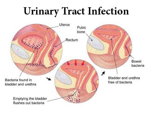 Urinary Tract Infections Urinary Tract Infections