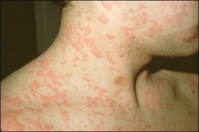 Urticaria Urticaria