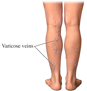 Varicose Veins Varicose Veins