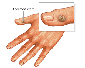 Wart Wart