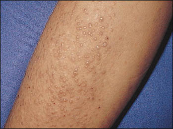Lichen amyloidosis Lichen amyloidosis