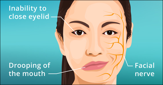Bell's Palsy Bell's Palsy, Facial Paralysis