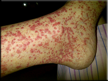 Leukocytoclastic Vasculitis Leukocytoclastic Vasculitis