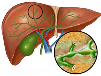 Primary Sclerosing Cholangitis Primary Sclerosing Cholangitis