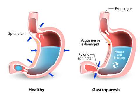 Gastroparesis Gastroparesis