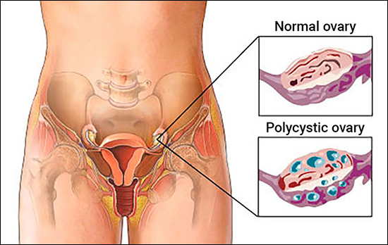 poly-cystic ovarian disorder poly-cystic ovarian disorder