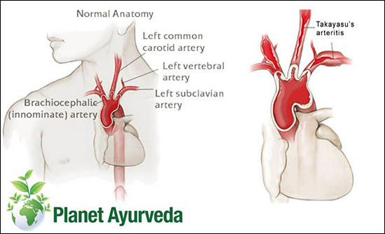 Takayasu’s Arteritis Takayasu’s Arteritis