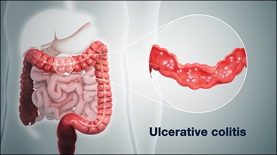 Ulcerative colitis, Bloody diarrhea, Weakness, Mucus in stool, Weight loss, Abdominal pain, Abdominal cramps