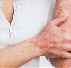 Atopic Dermatitis or Eczema Constipation