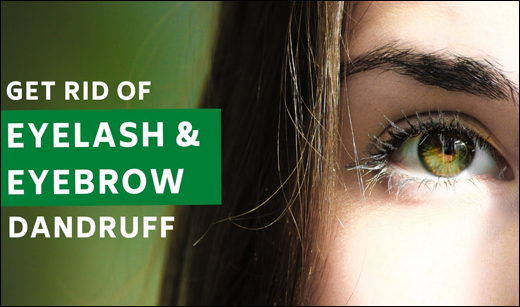 Get Rid of Eyelashes & Eyebrows Dandruff Blepharitis, Symptoms of Blepharitis, Causes of Blepharitis, Ayurvedic view on Blepharitis, Home remedies, Home remedies to prevent dandruff on eyelashes & eyebrows