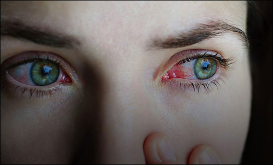 Conjunctivitis (Pink Eye) Conjunctivitis, Pink Eye, An Ayurvedic Perspective